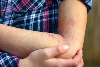 Navarra registra una veintena de casos de lupus infantil